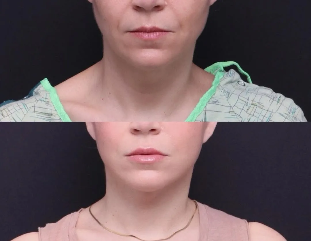 Before and after — Dr. Mitchell Hagen