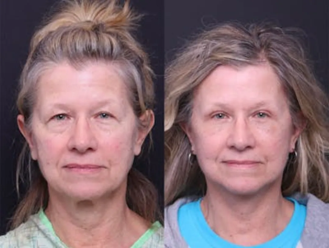 Before and after — Dr. Mitchell Hagen