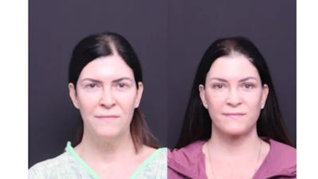 Before and after — Dr. Mitchell Hagen