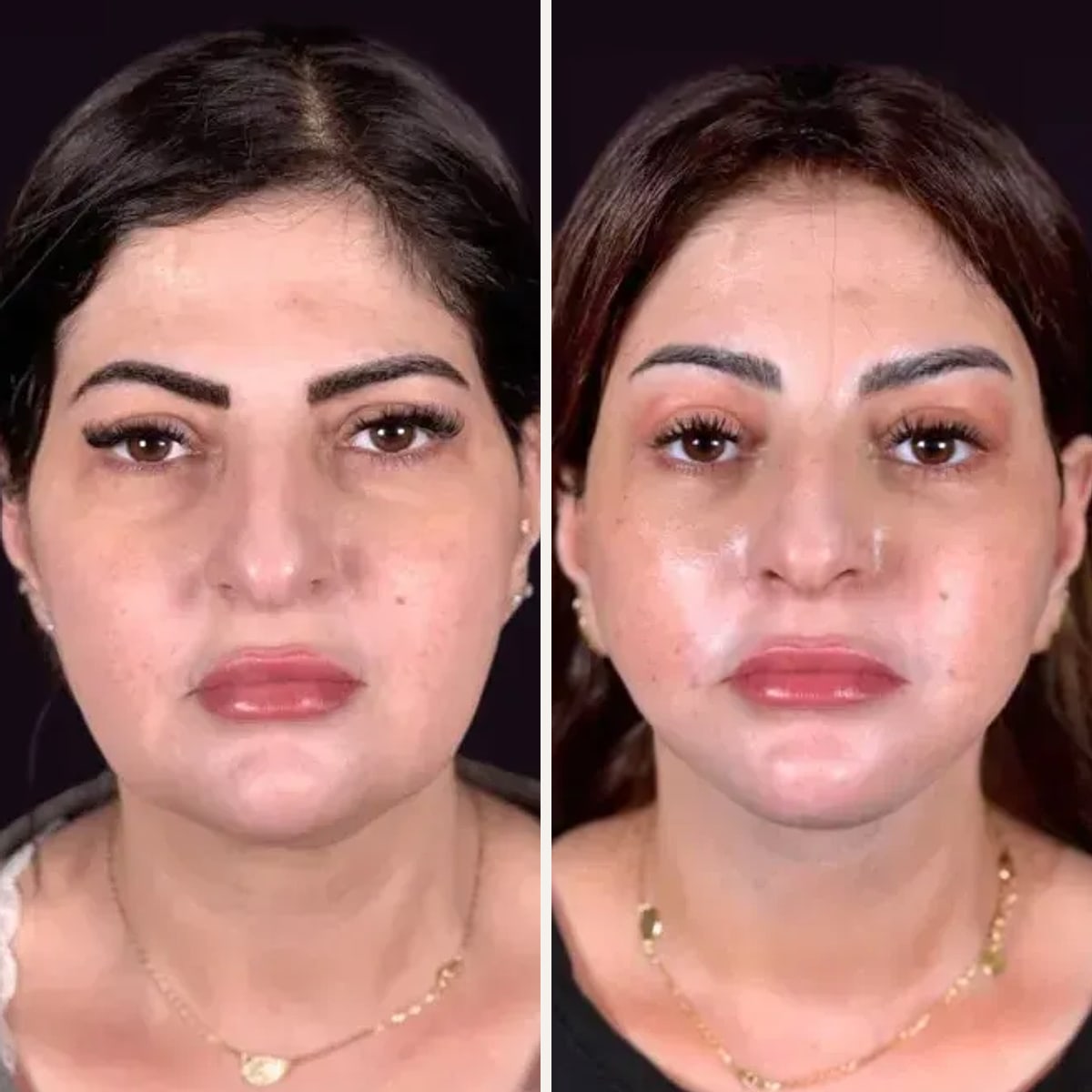 До и после — Deep Plane Facelift от доктора Moh Mamdouh