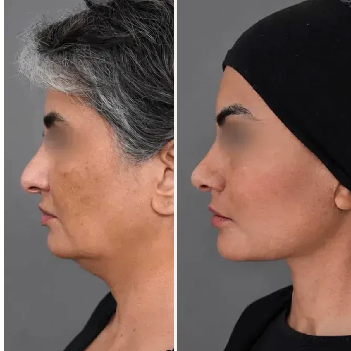 Before & After - Deep Plane Facelift by Dr. Mohammed Alghoul