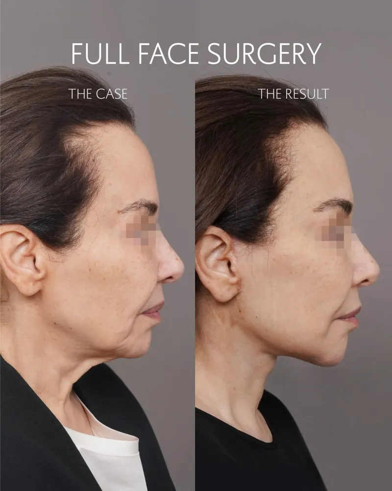 Before and after: Dr. Mohammed Alghoul