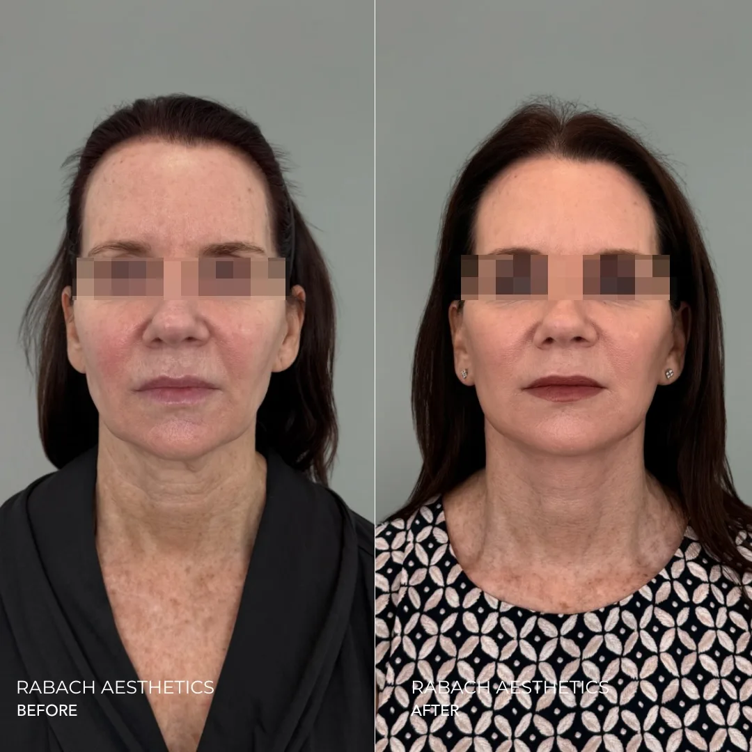 Before and after deep plane facelift — 55-year-old woman, frontal view, 6mo post-op by Dr. Morgan Rabach
