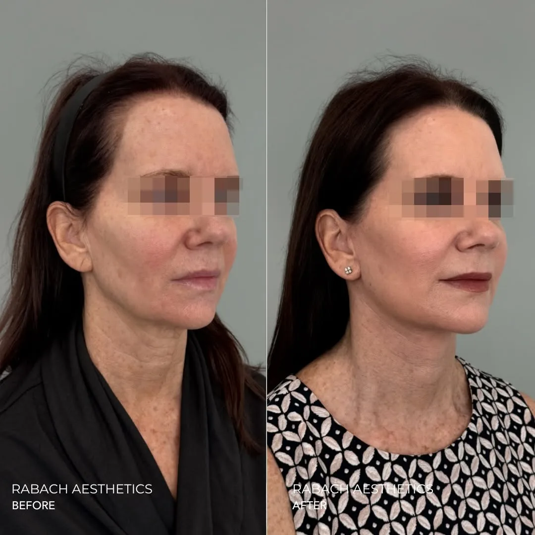 Before and after deep plane facelift — 52-year-old woman, oblique left view, 6mo post-op by Dr. Morgan Rabach