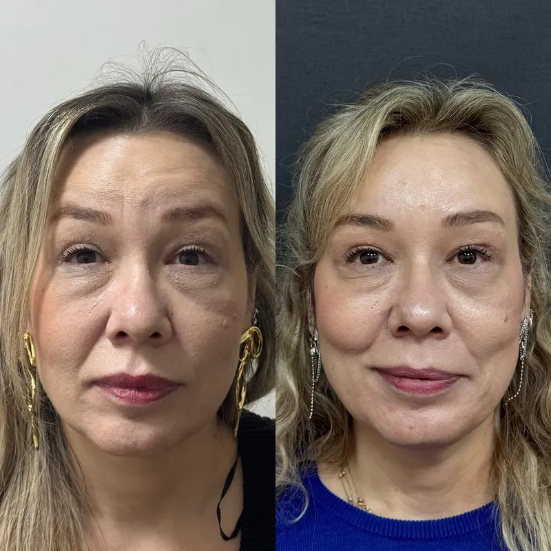 Before and after — Dr. Muaz Zuhurlu