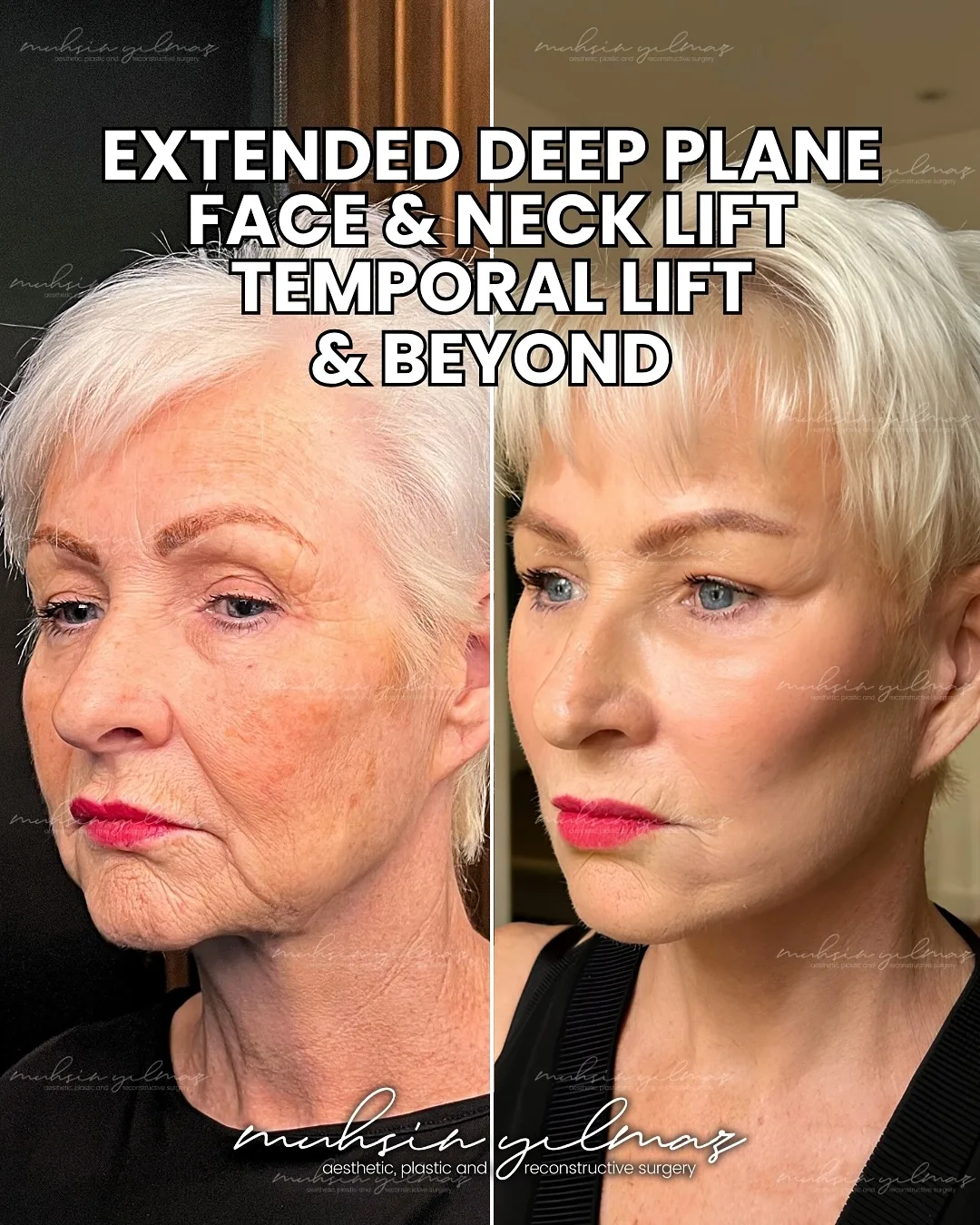 Before and after — Dr. Muhsin Yılmaz