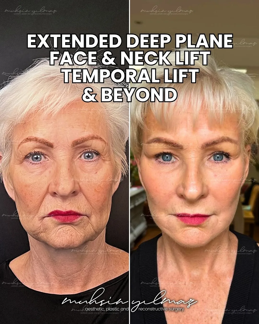 Before and after — Dr. Muhsin Yılmaz