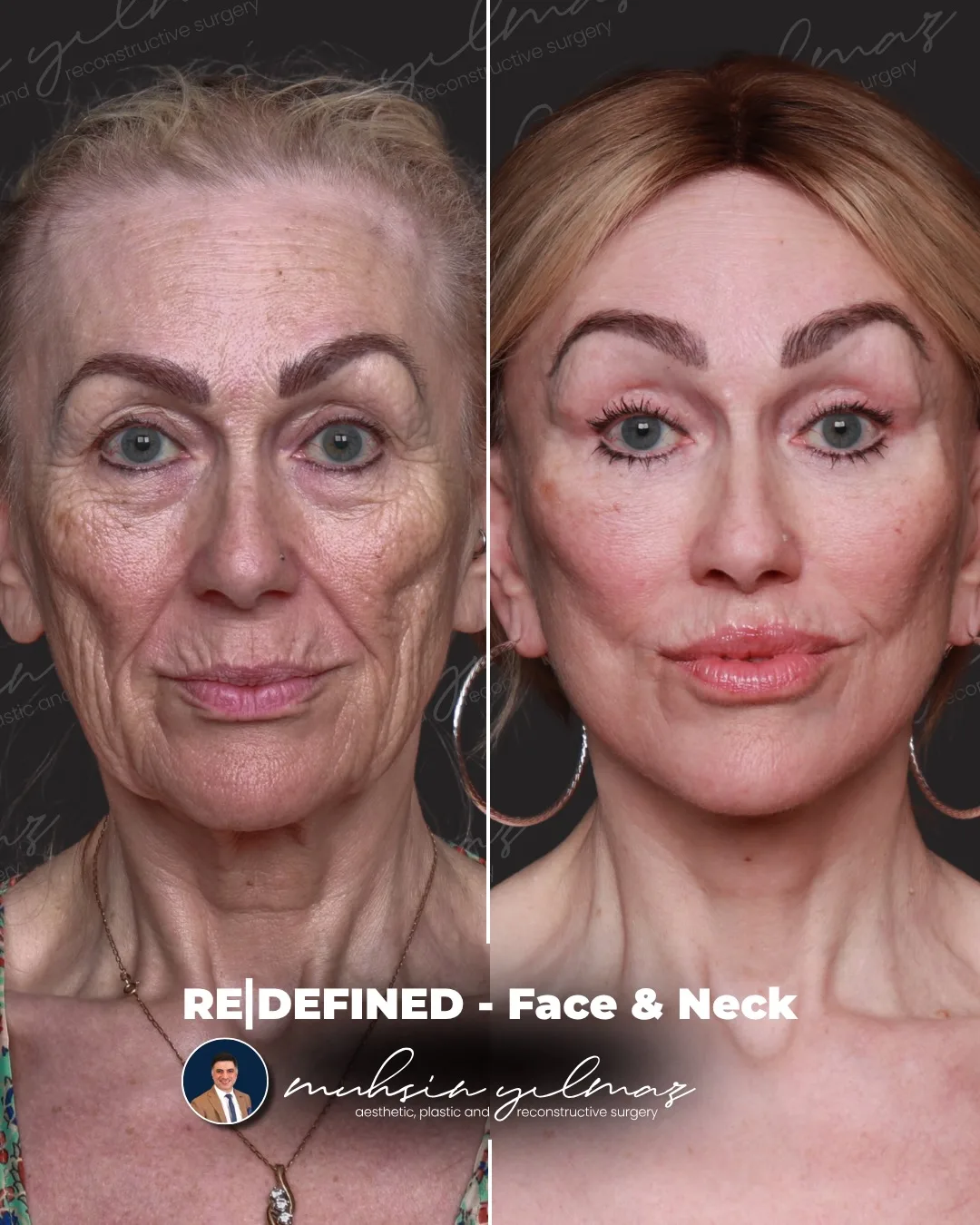Before and after — Dr. Muhsin Yılmaz