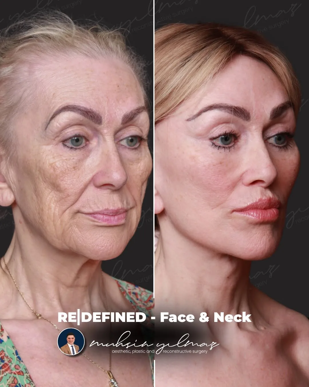 Before and after — Dr. Muhsin Yılmaz