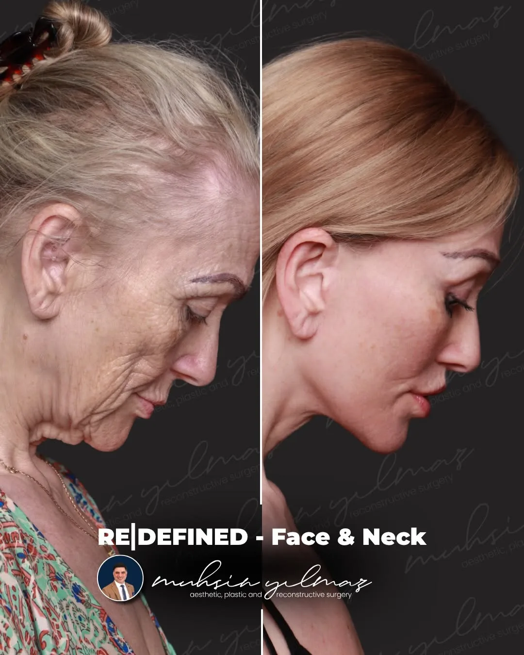 Before and after — Dr. Muhsin Yılmaz