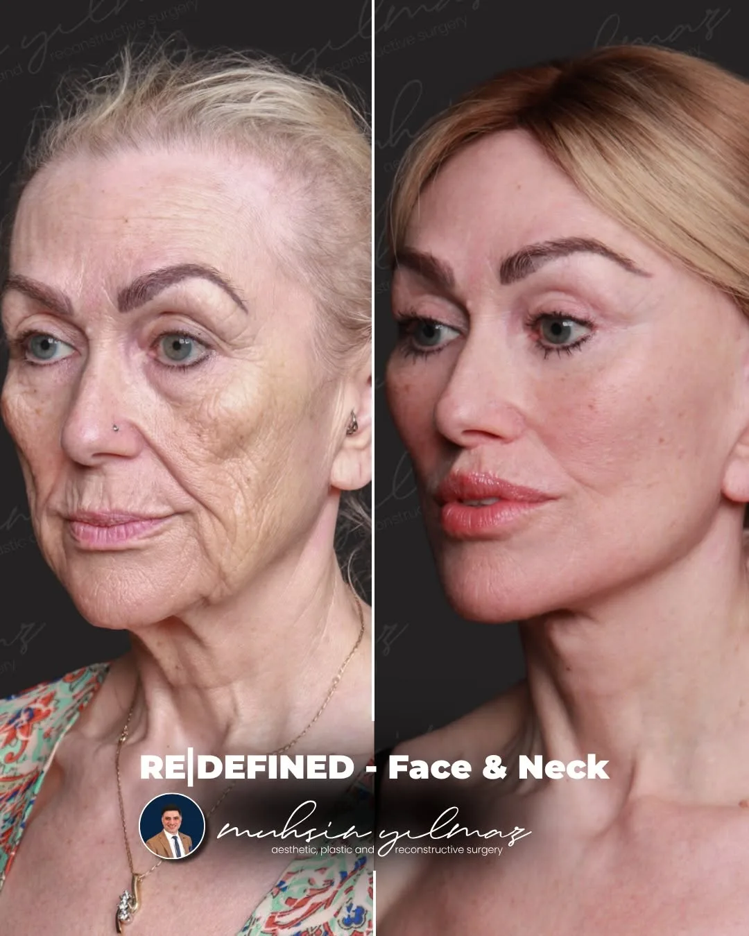 Before and after — Dr. Muhsin Yılmaz