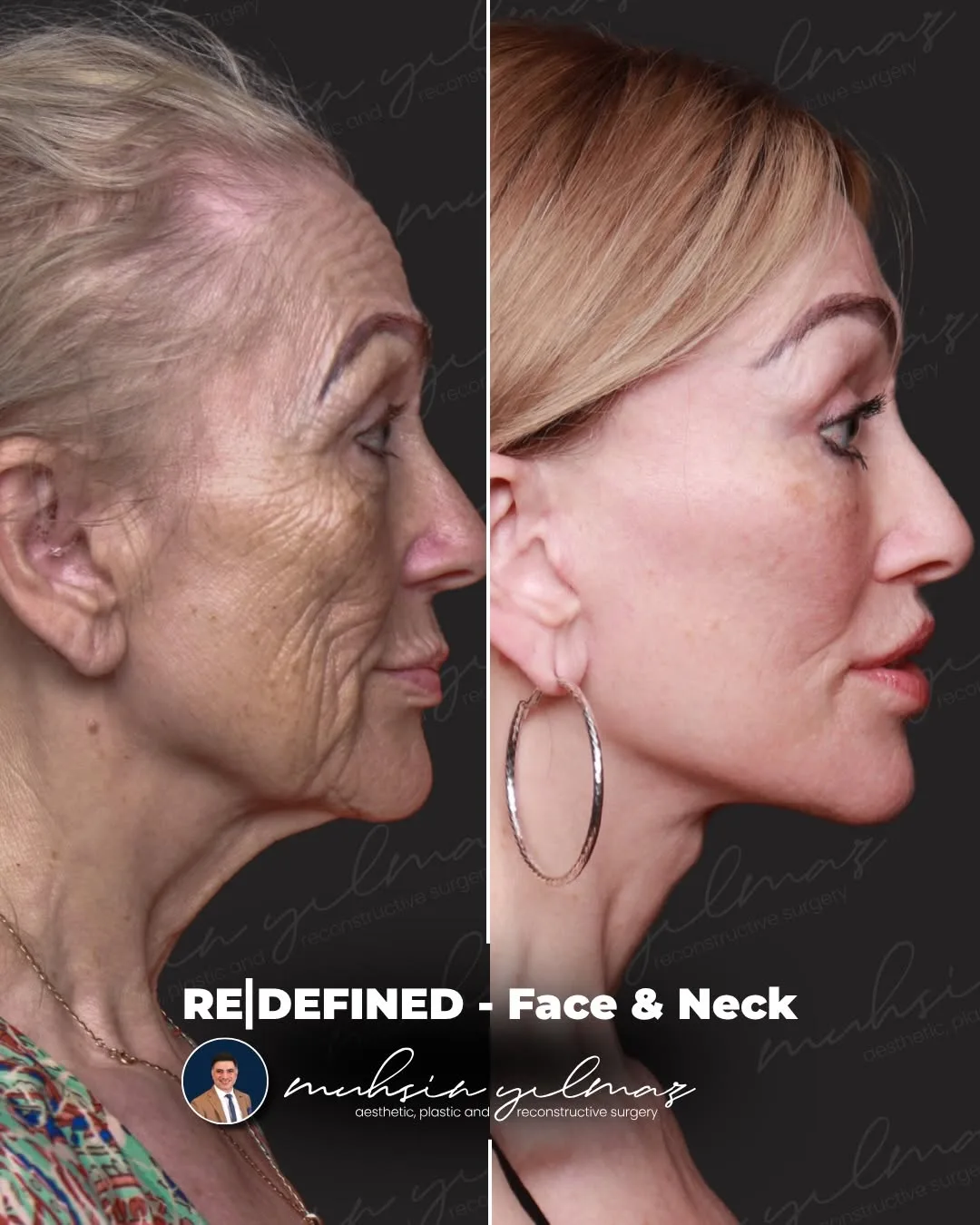Before and after — Dr. Muhsin Yılmaz
