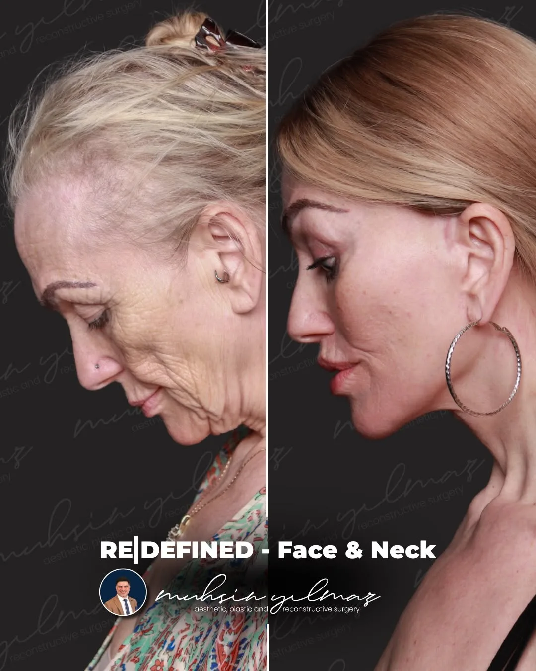 Before and after — Dr. Muhsin Yılmaz