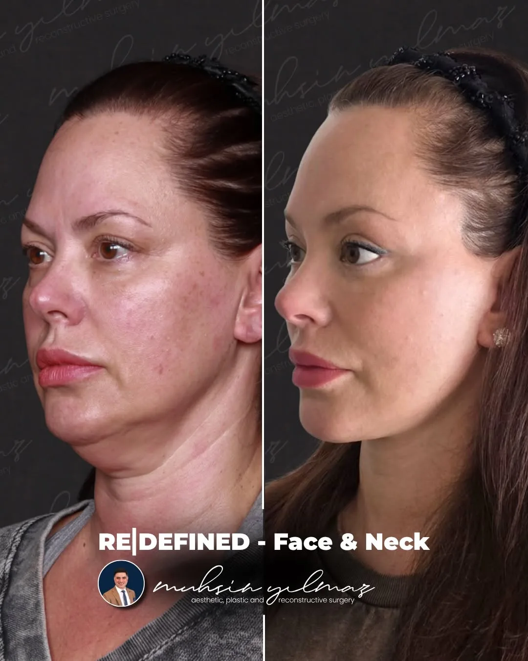Before and after: Dr. Muhsin Yılmaz