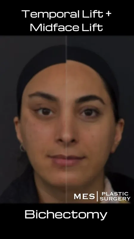 Before and after — Dr. Murat Enes Sağlam