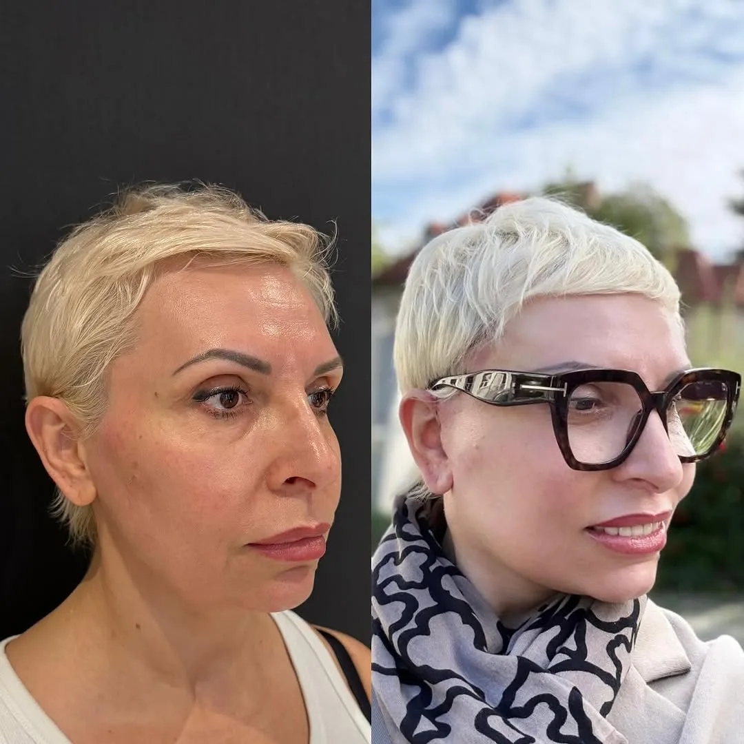 Before and after — Dr. Mustafa Özyurtlu