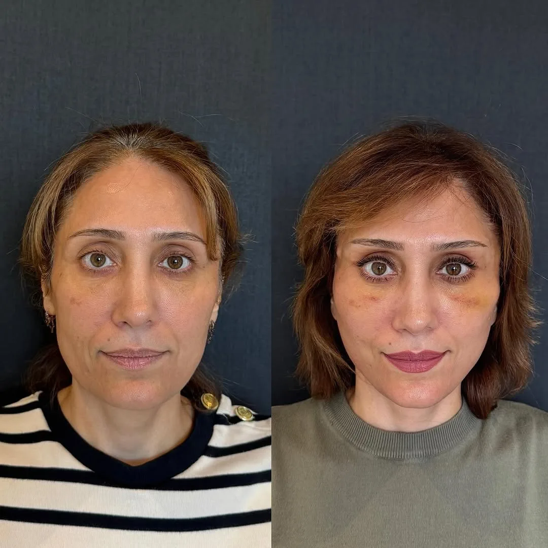 Before and after — Dr. Mustafa Özyurtlu