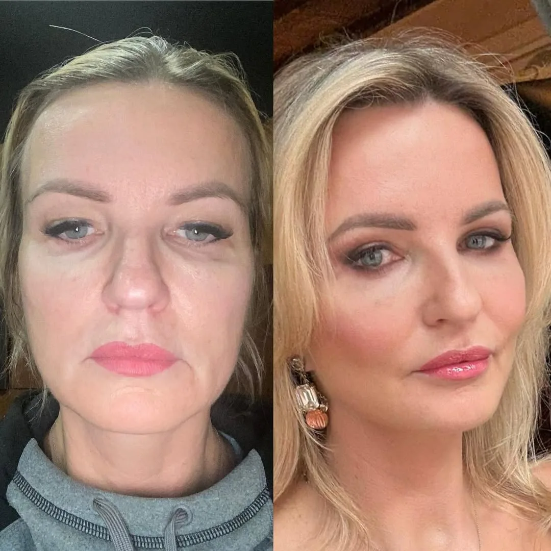 Before and after — Dr. Mustafa Özyurtlu