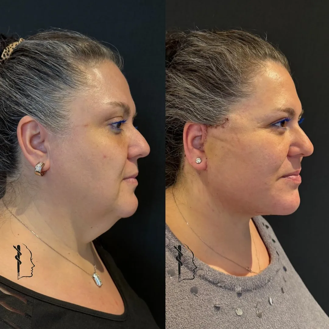 Before and after — Dr. Mustafa Özyurtlu