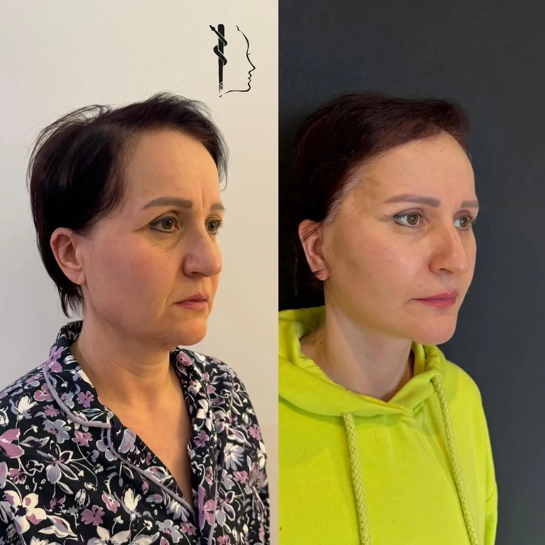 Before and after — Dr. Mustafa Özyurtlu