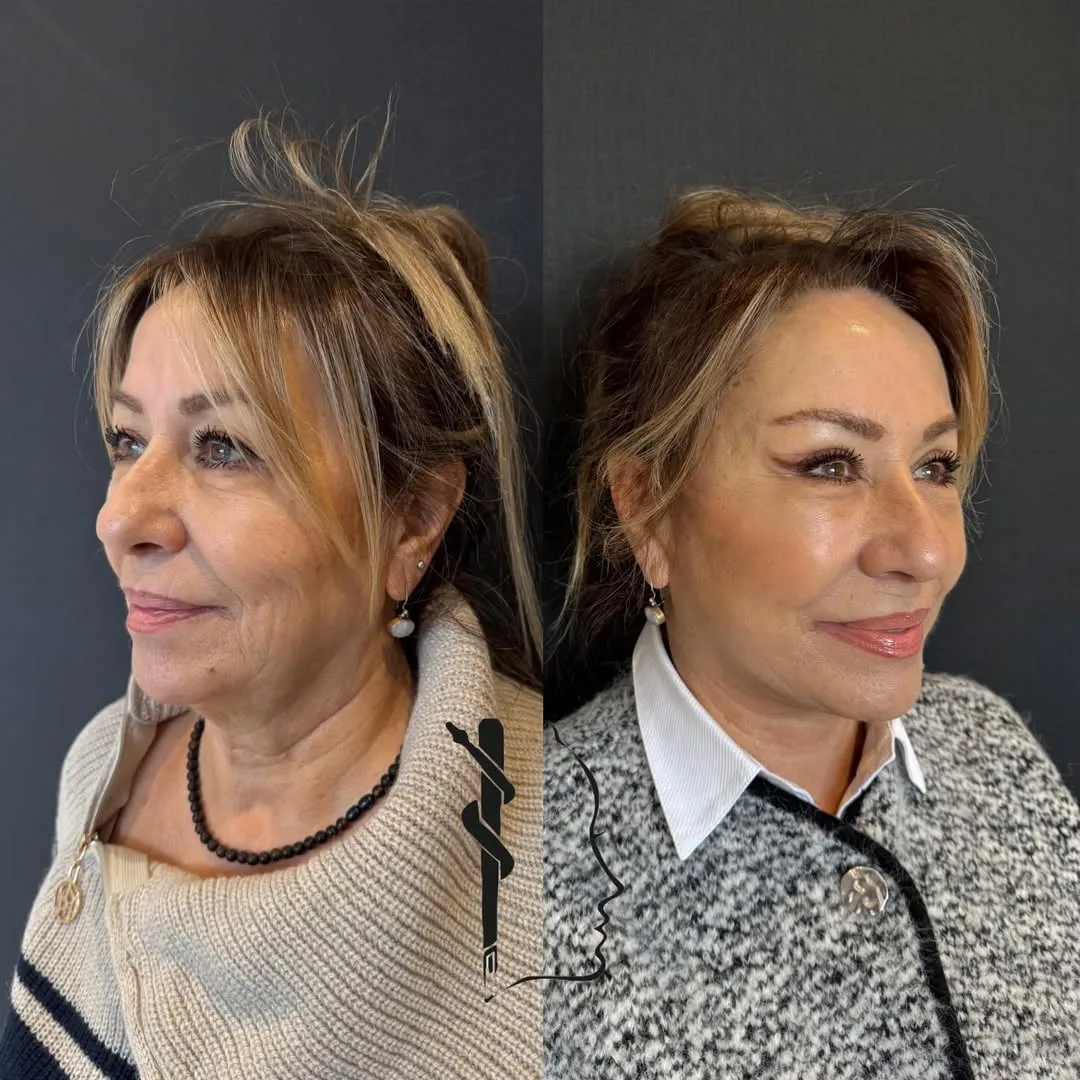 Before and after — Dr. Mustafa Özyurtlu