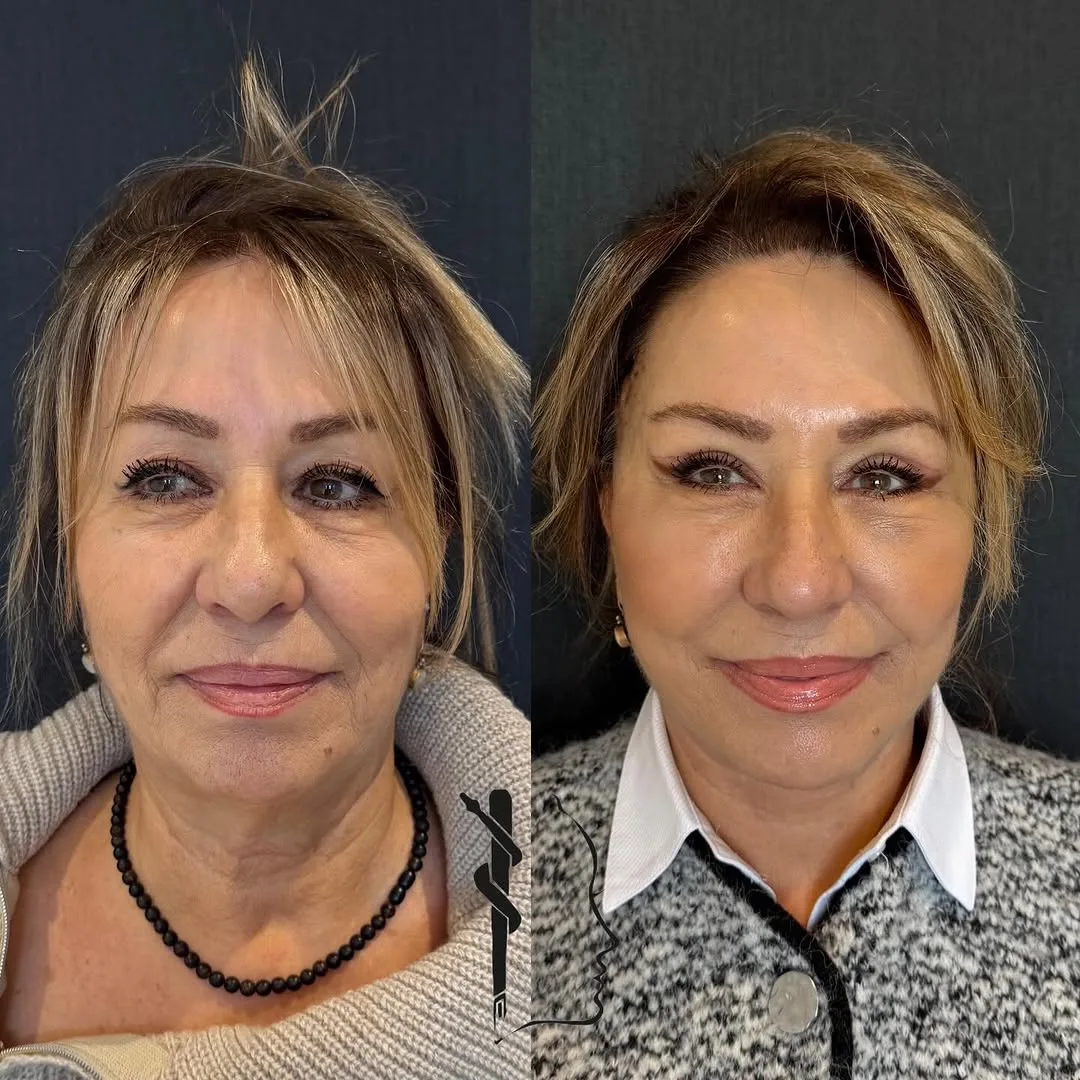 Before and after — Dr. Mustafa Özyurtlu