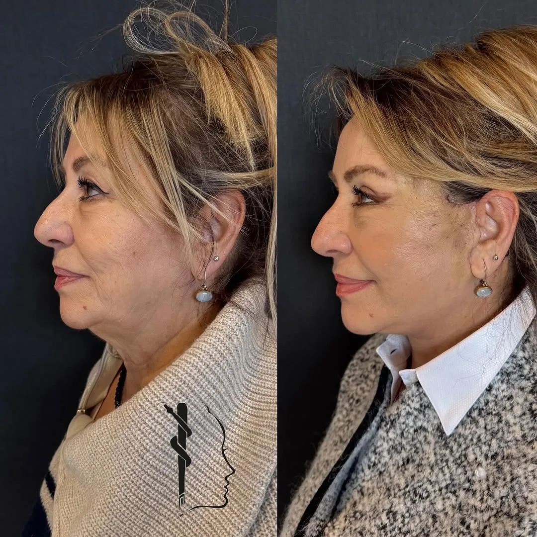 Before and after — Dr. Mustafa Özyurtlu