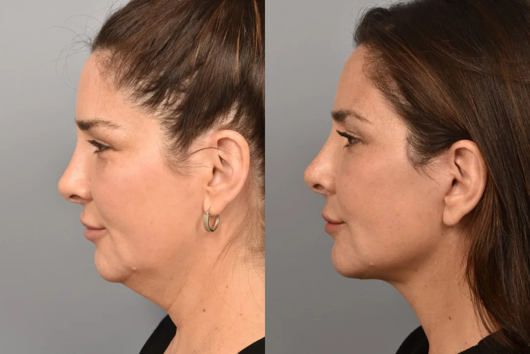 Before and after — Dr. Muthana Shikara