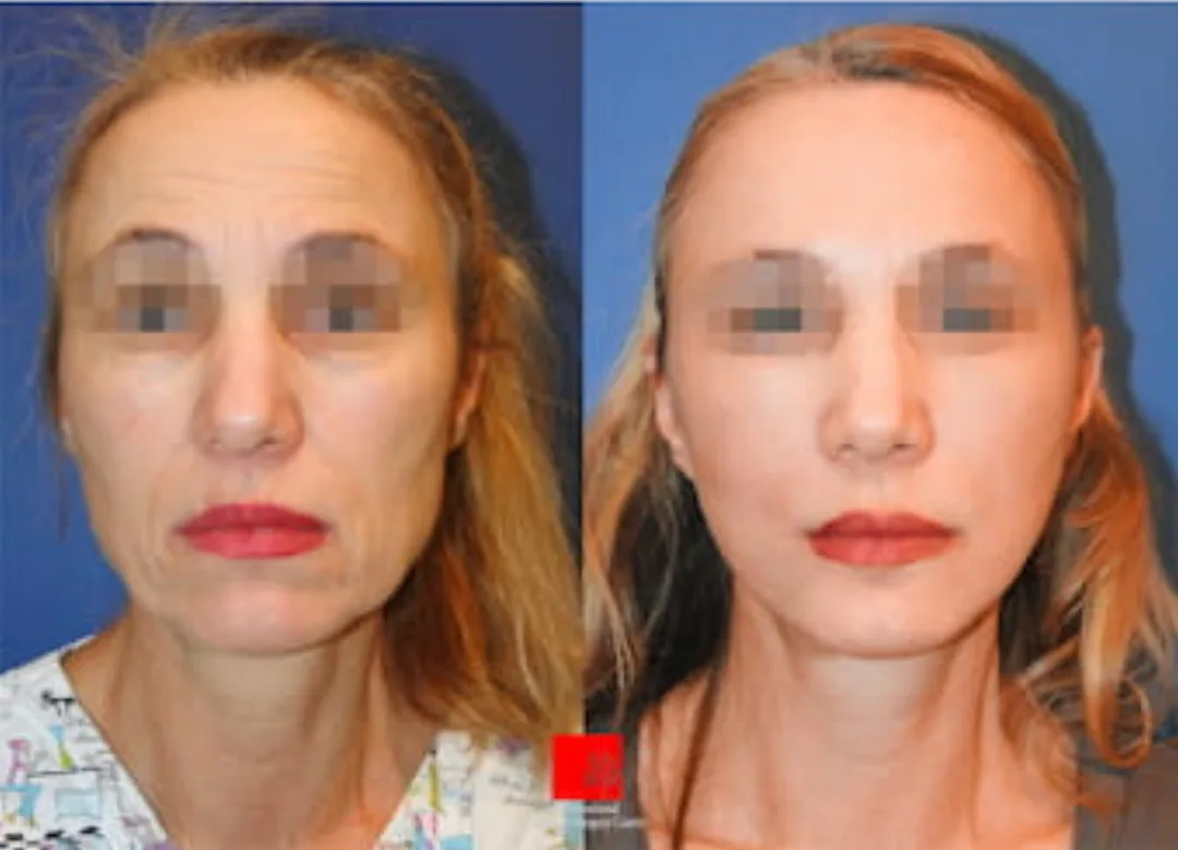 Before and after — Dr. Myung Ju Lee