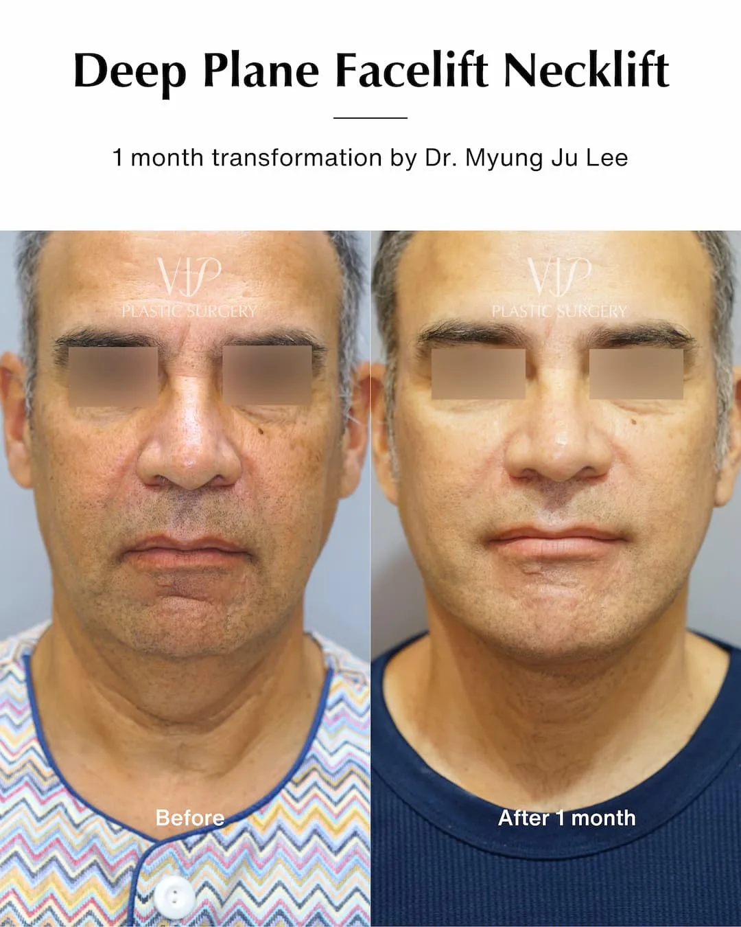 Before and after — Dr. Myung Ju Lee