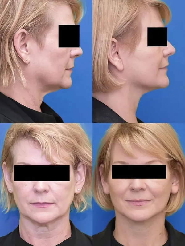 Before and after — Dr. Neal Goldberg