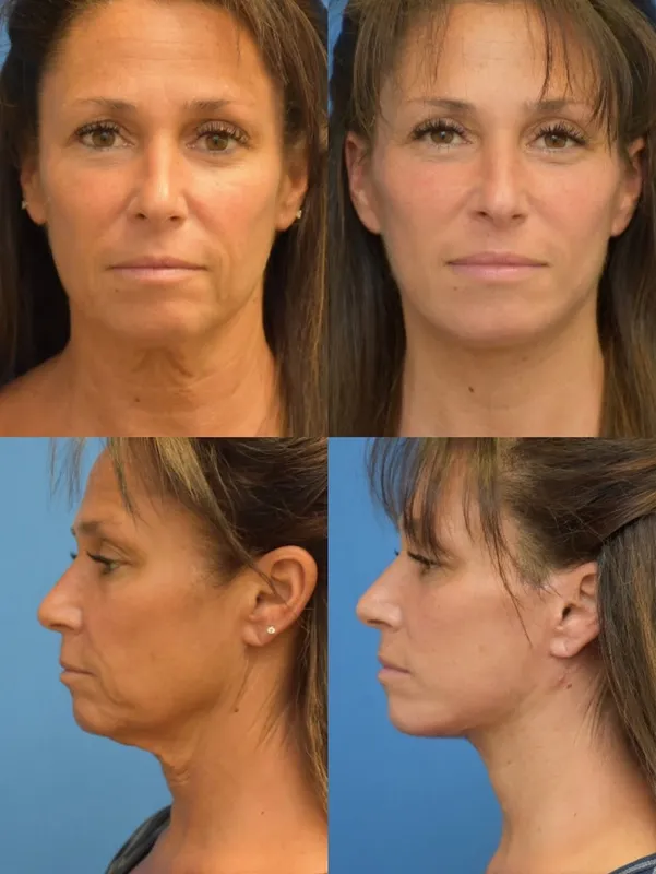 Before and after — Dr. Neal Goldberg