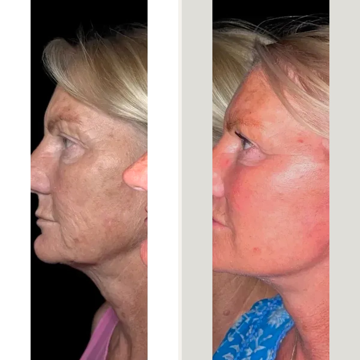 Before & After - Deep Plane Facelift by Dr. Neophytos Demetriades