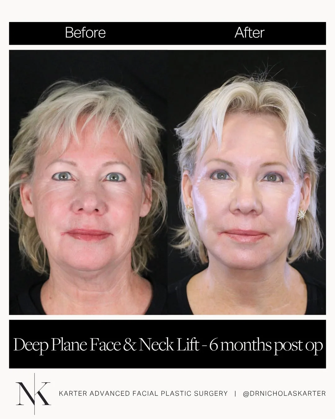 Before and after — Dr. Nicholas Karter