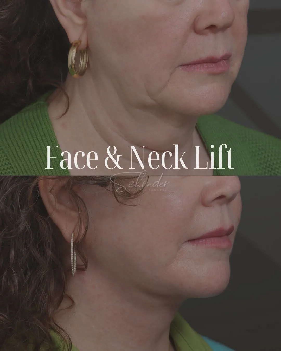 Before and after — Dr. Nicole Schrader