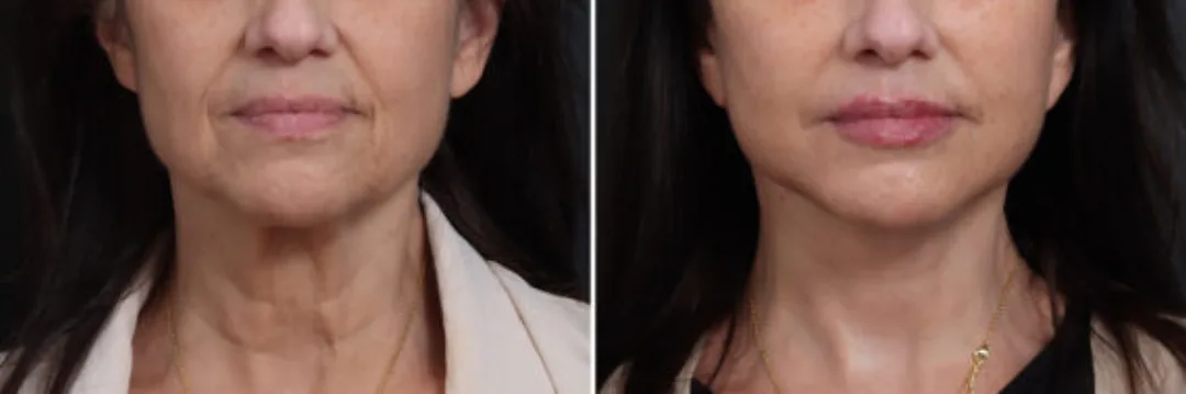Before and after — Dr. Nicole Schrader