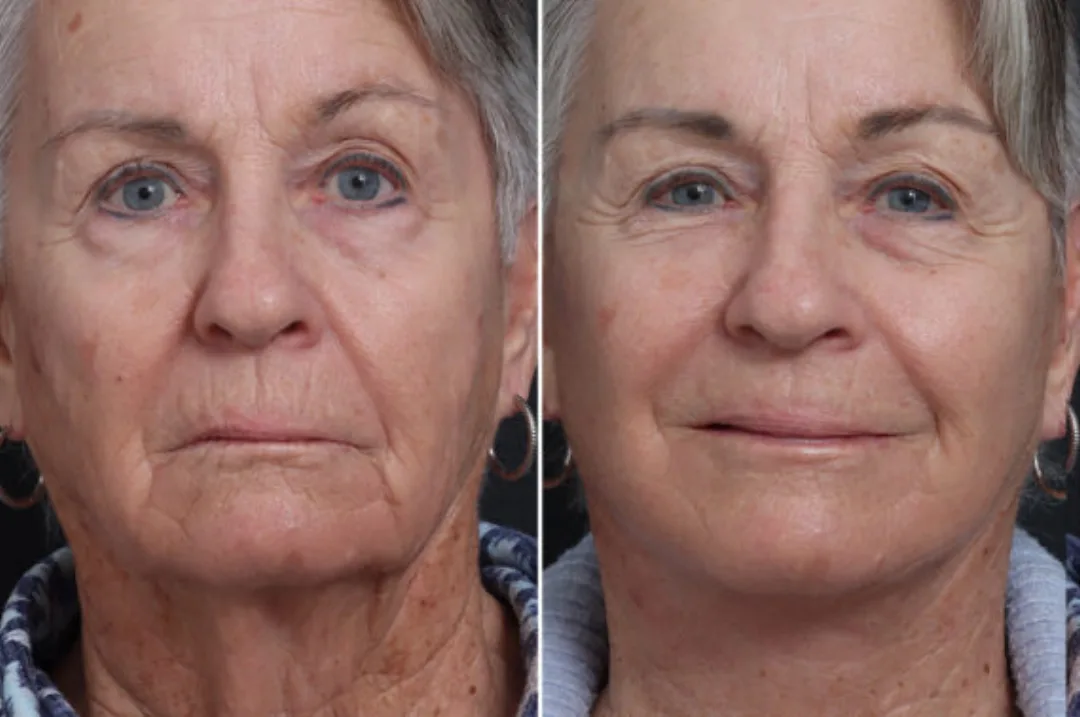 Before and after — Dr. Nicole Schrader