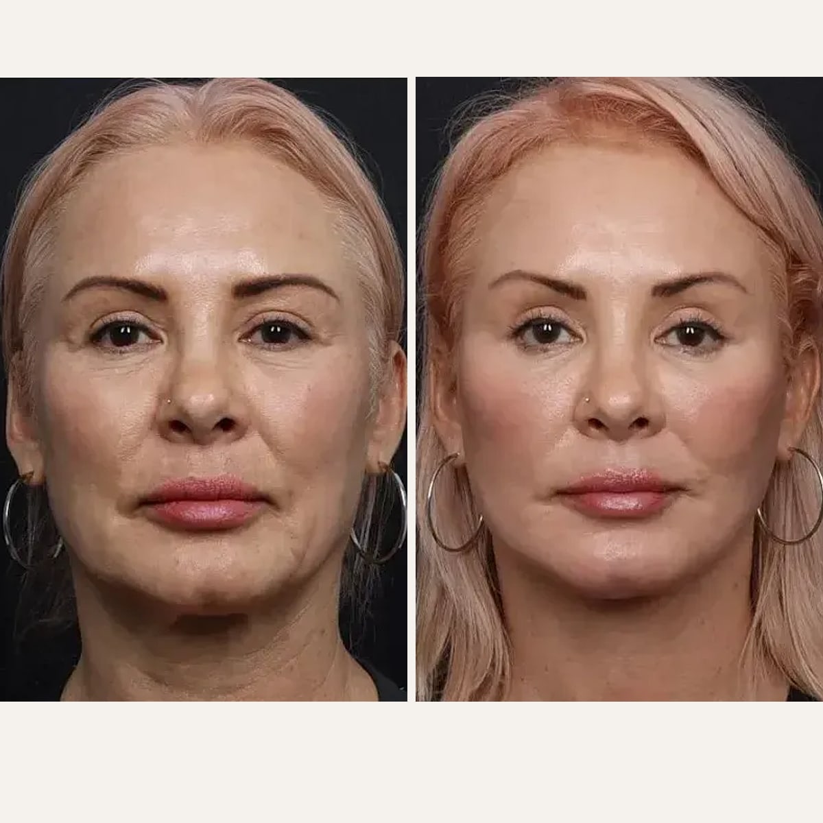 До и после — Deep Plane Facelift от доктора Nima Shemirani