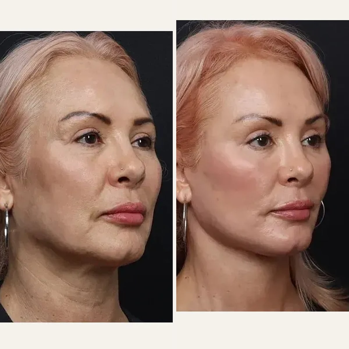 До и после — Deep Plane Facelift от доктора Nima Shemirani