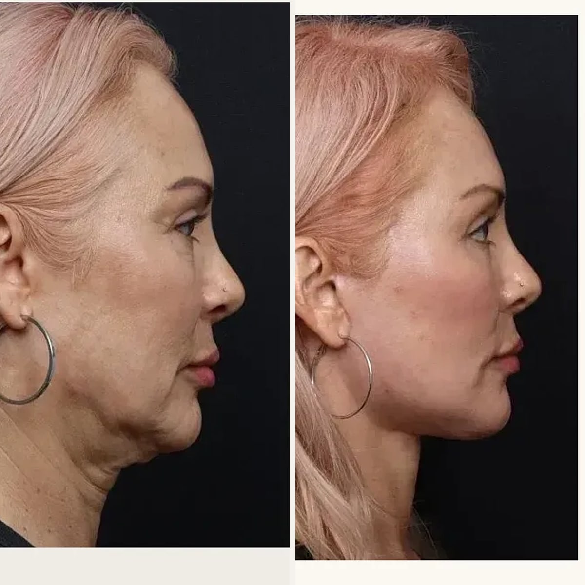 До и после — Deep Plane Facelift от доктора Nima Shemirani