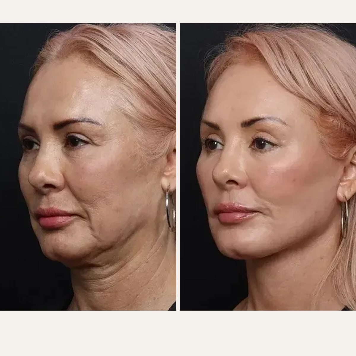 До и после — Deep Plane Facelift от доктора Nima Shemirani