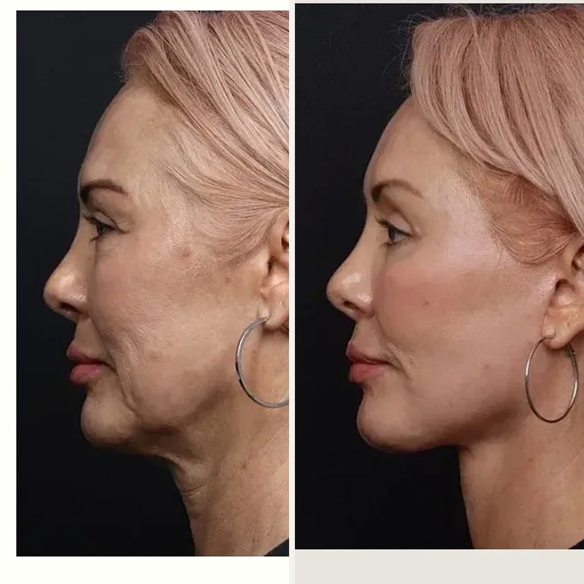До и после — Deep Plane Facelift от доктора Nima Shemirani