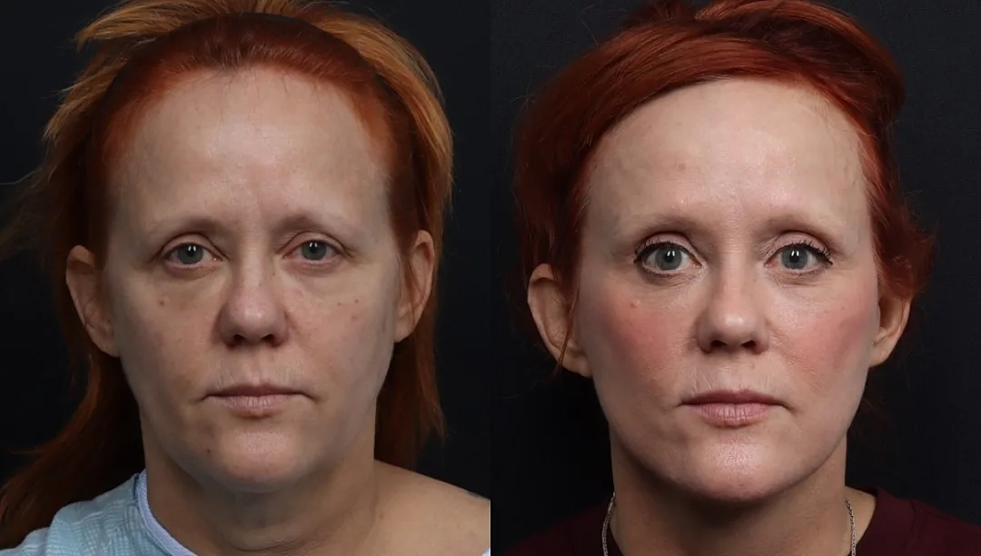 До и после — Deep Plane Facelift от доктора Nima Shemirani