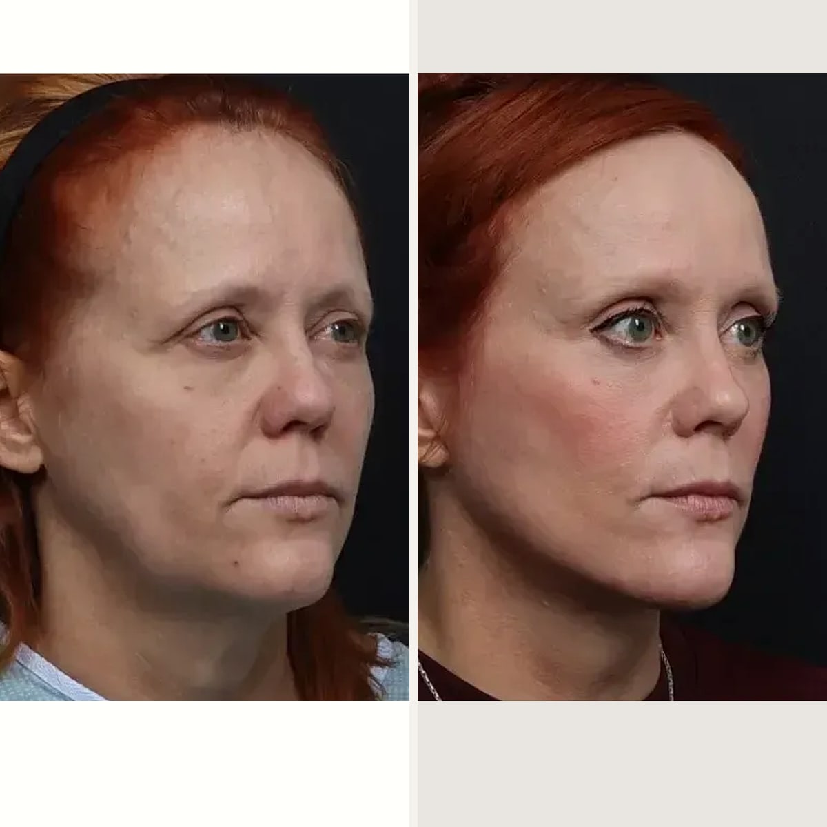 До и после — Deep Plane Facelift от доктора Nima Shemirani
