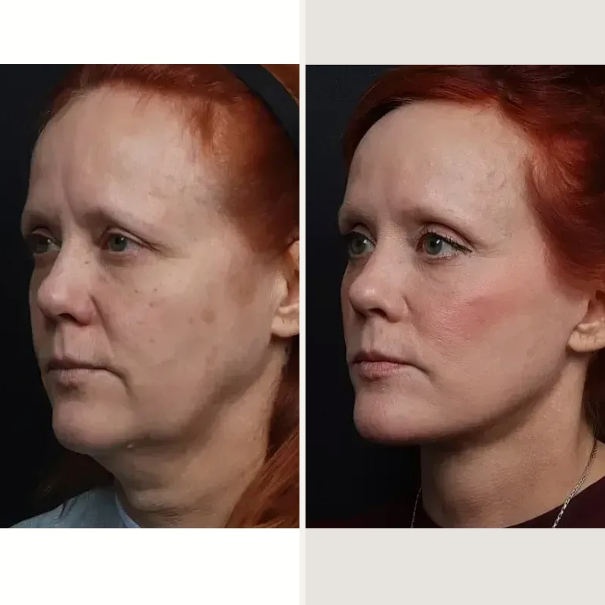 До и после — Deep Plane Facelift от доктора Nima Shemirani