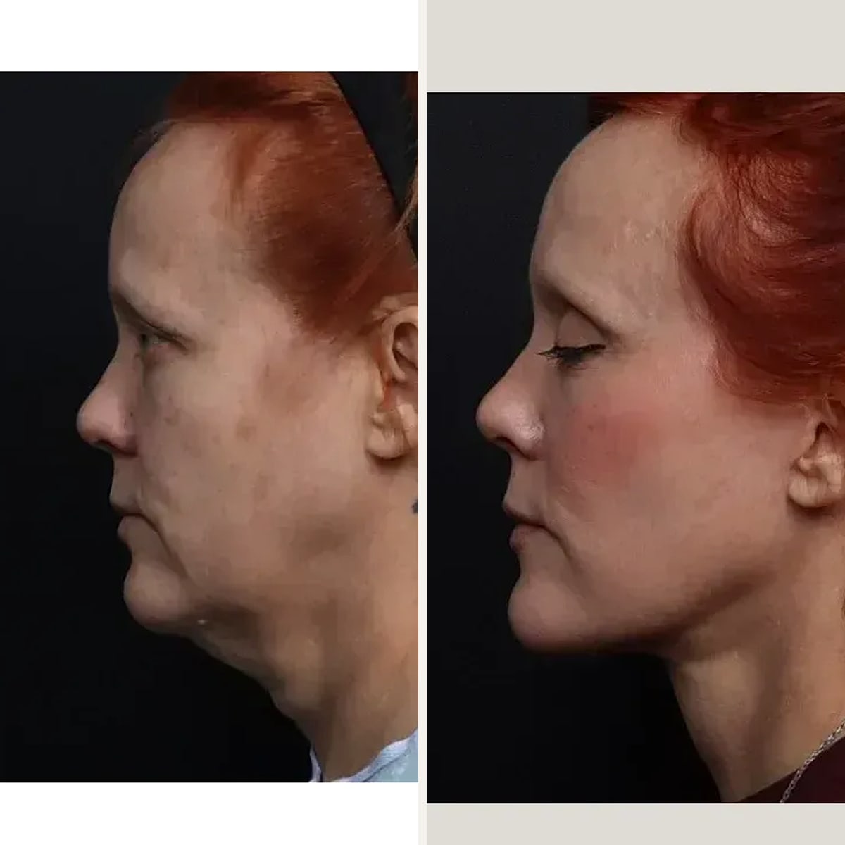 Before & After - Deep Plane Facelift by Dr. Nima Shemirani
