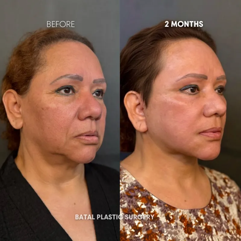 Before and after — Dr. Obaida Batal
