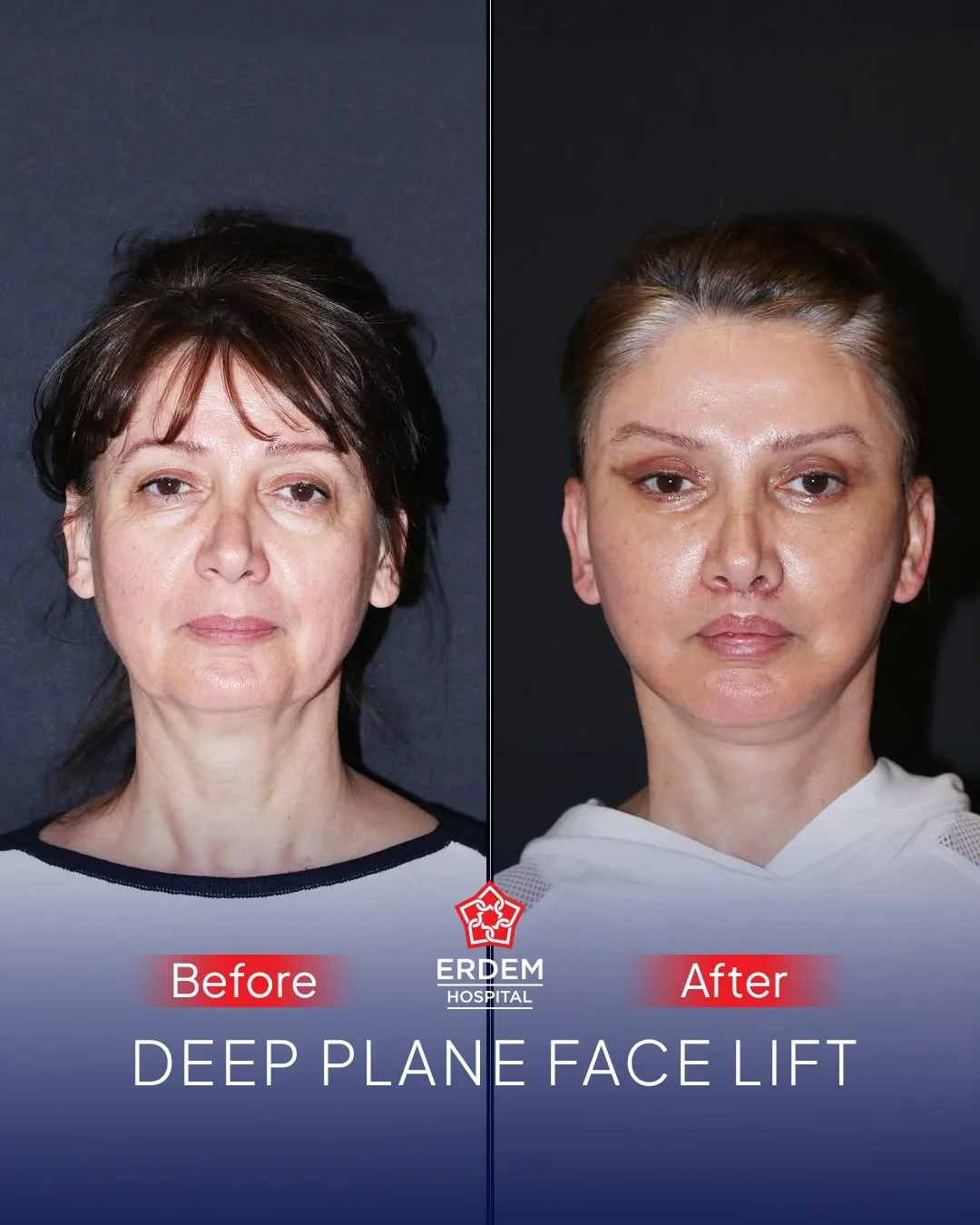 Before and after deep plane facelift — 52-year-old woman, frontal view, 6mo post-op by Dr. Oğuz Boyraz