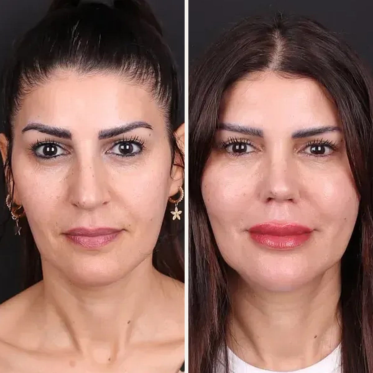 Before and after: Dr. Oğuzhan Aydoğdu