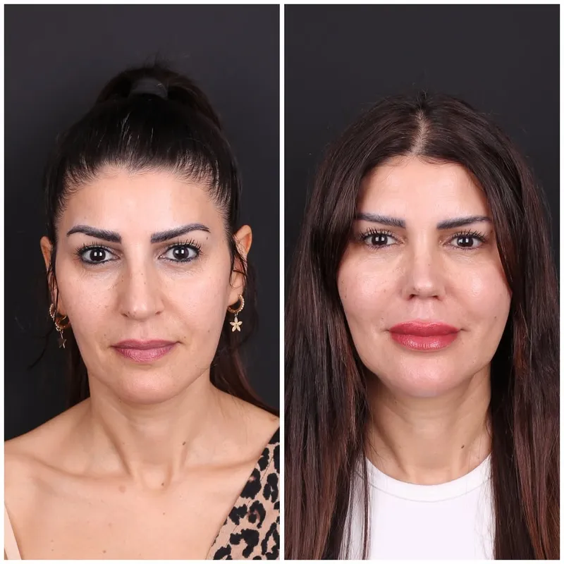 Before and after deep plane facelift — -1-year-old patient, frontal view by Dr. Oğuzhan Aydoğdu